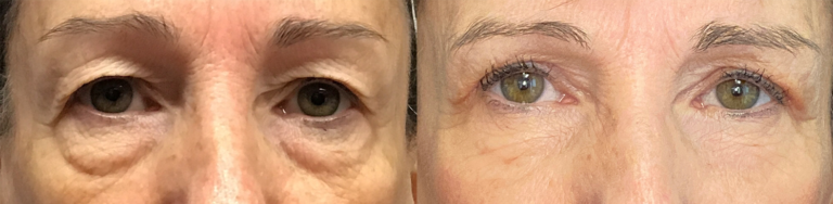 AccutiteMorpheus-upper-and-lower-eyelids
