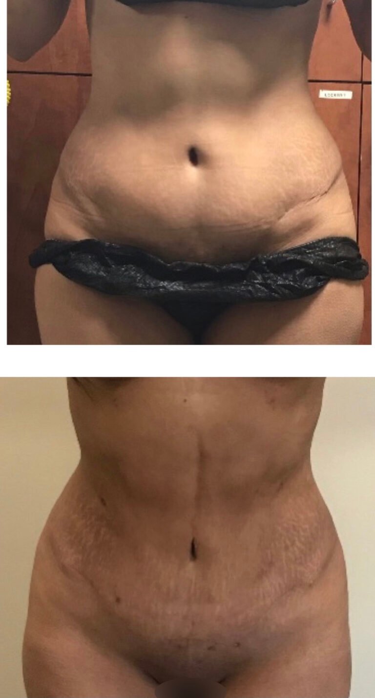 BodytiteLipo