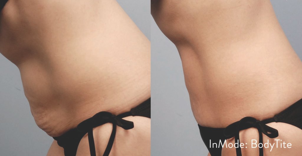 BodytiteLipo-IM_SM-MommyTummy