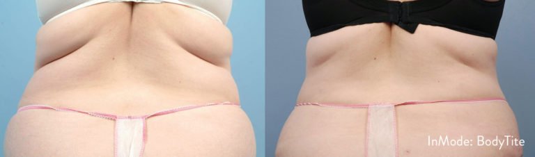BodytiteLipo-IM_SM_Back