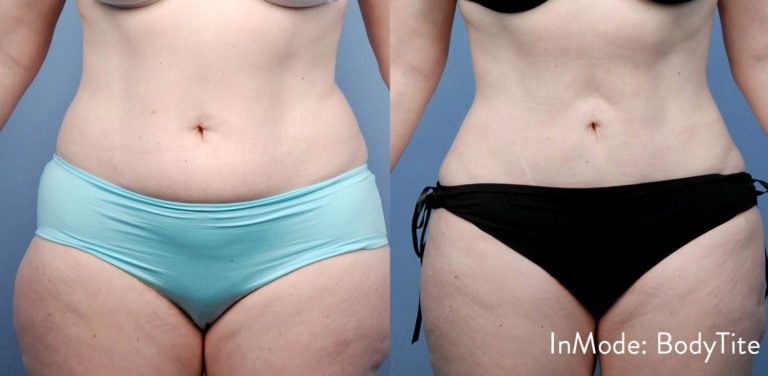 BodytiteLipo
