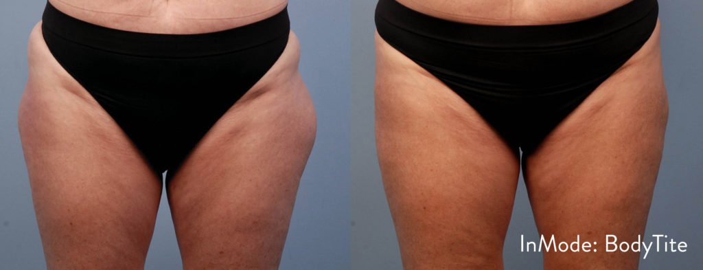 BodytiteLipo-IM_Stephen-Mulholland-Thigh-6Wk