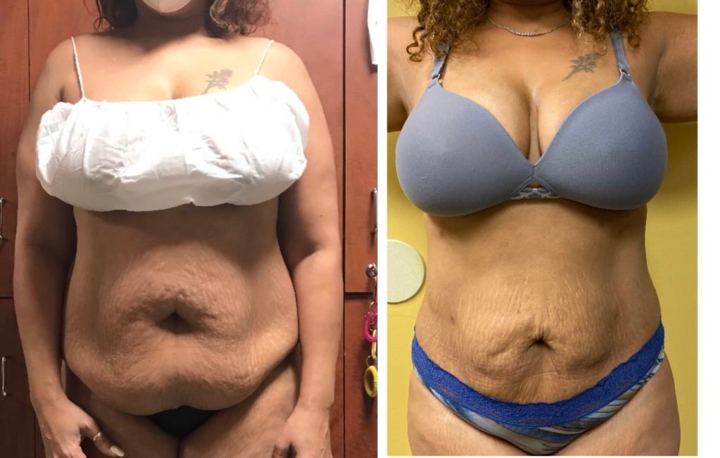 BodytiteLipo-Jeanette