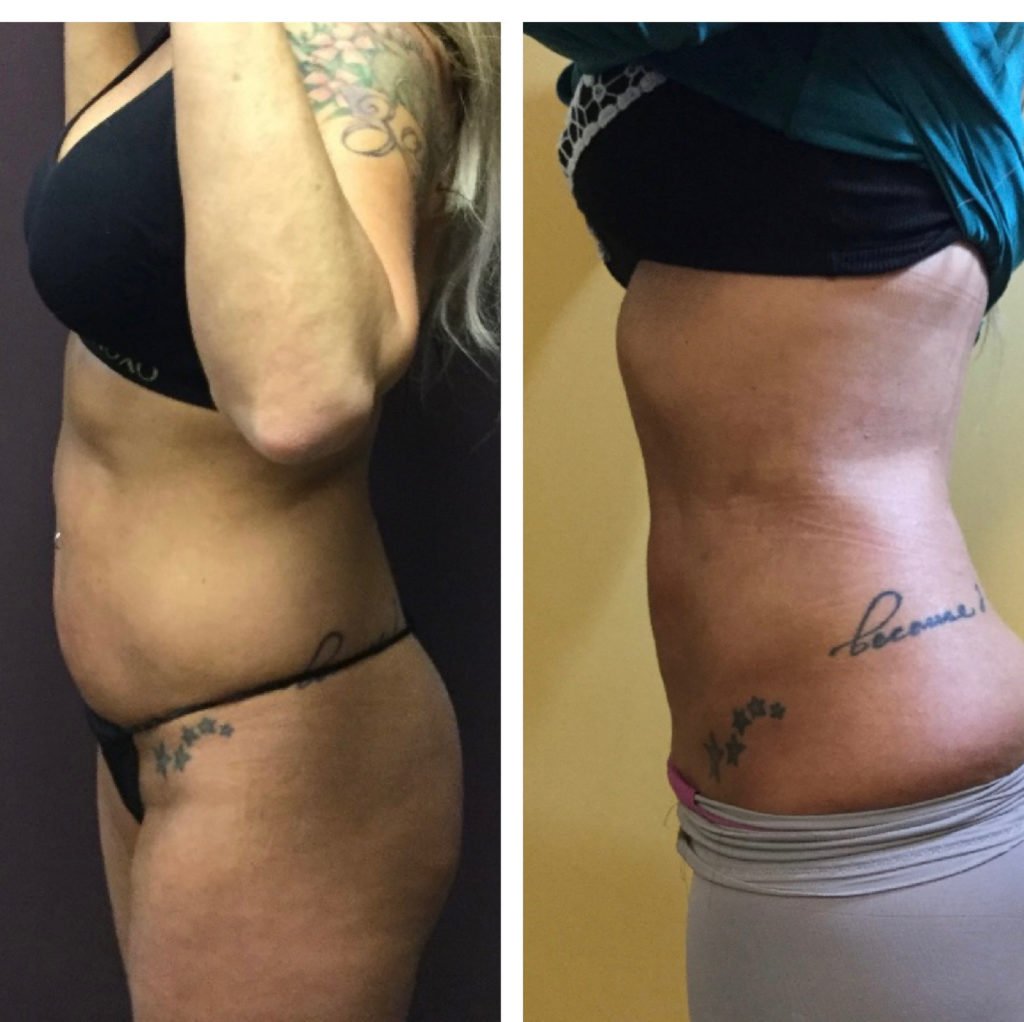BodytiteLipo-Lipo-3M-UL-Abdomen-and-Flanks