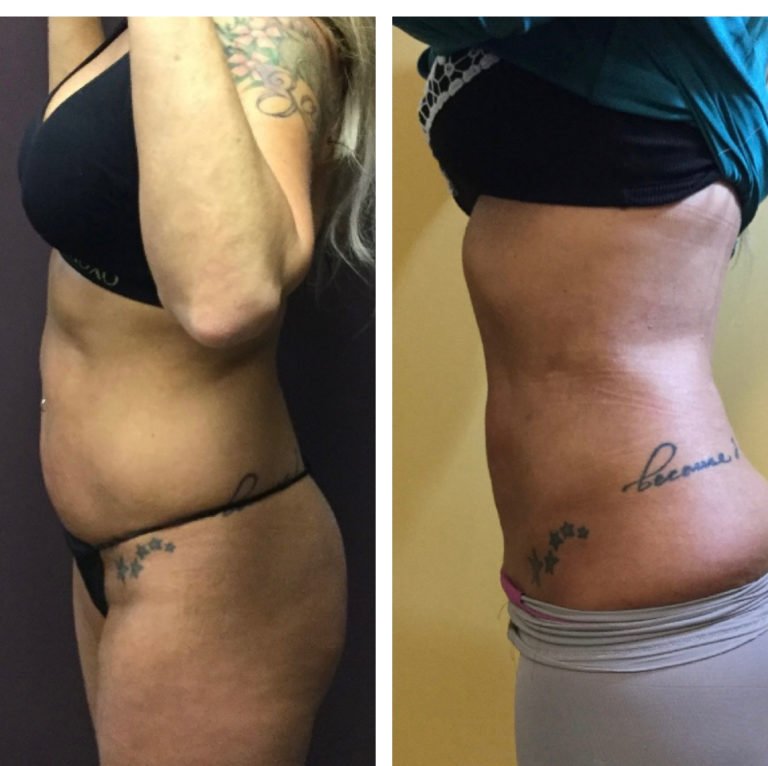 BodytiteLipo-Lipo