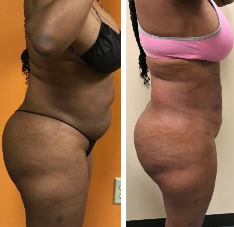 BodytiteLipo-ONE-day-post-SmartLipo