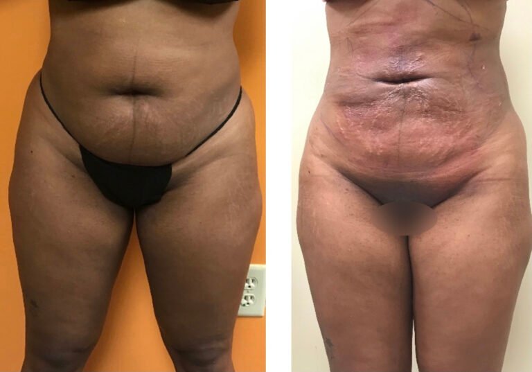 BodytiteLipo