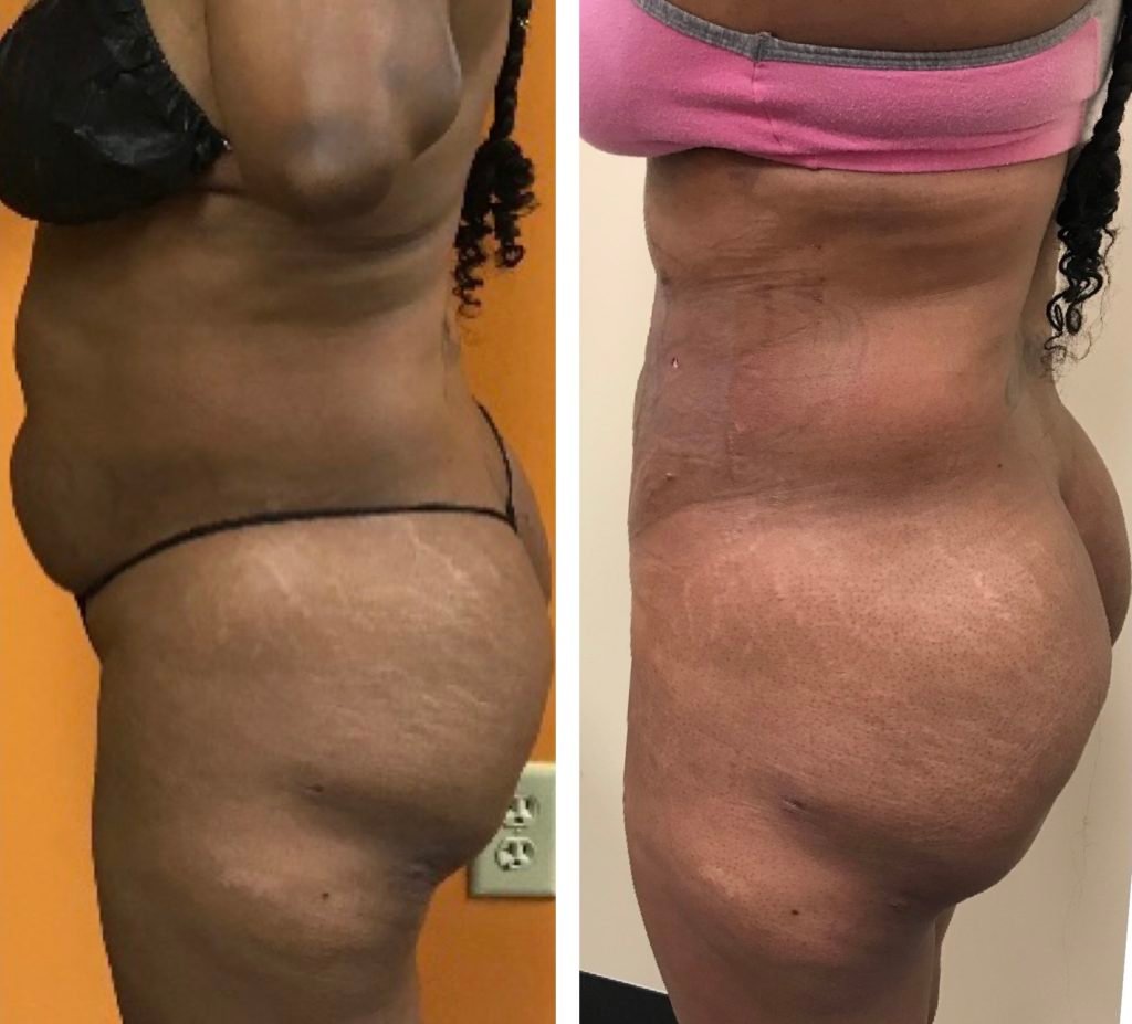 BodytiteLipo-ONE-day-post-SmartLipoR