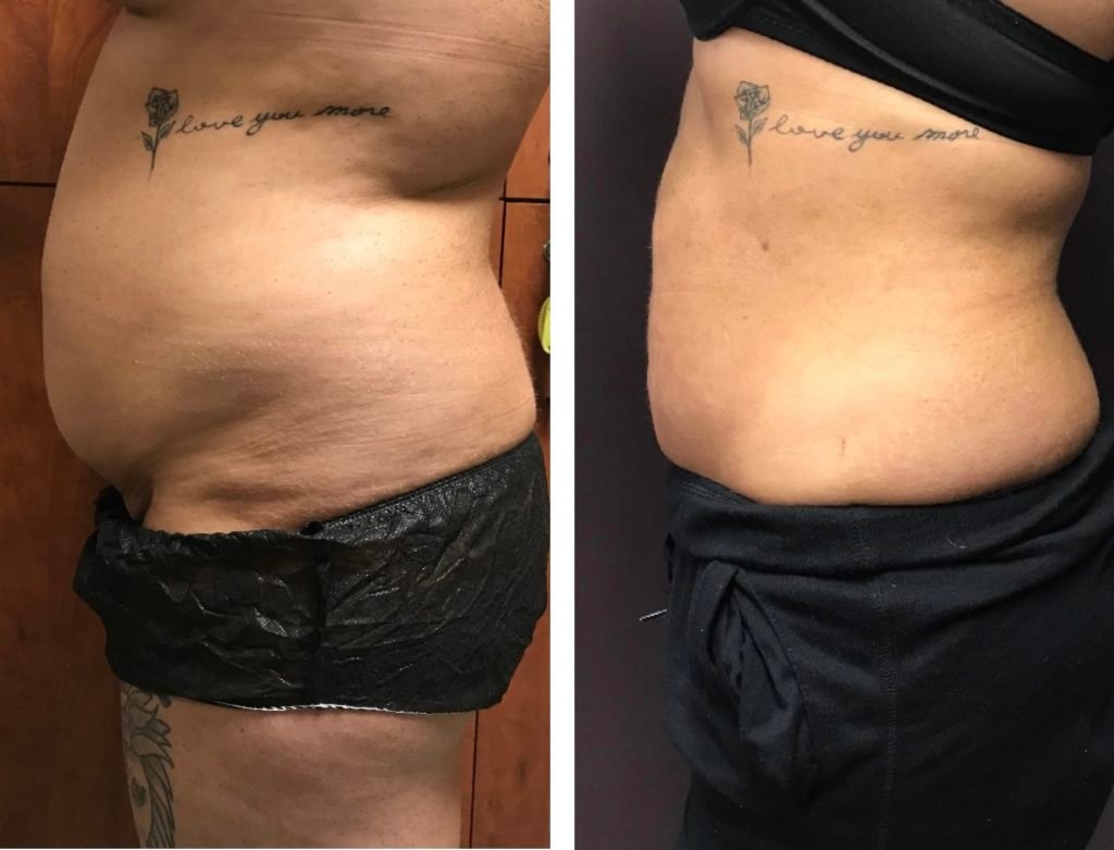 BodytiteLipo-SmartLipo-2M-after