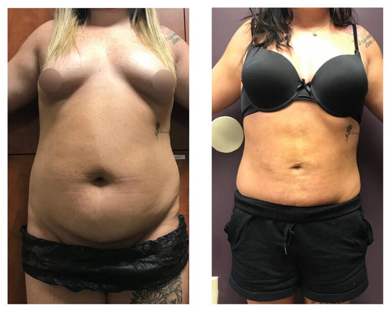 BodytiteLipo-SmartLipo