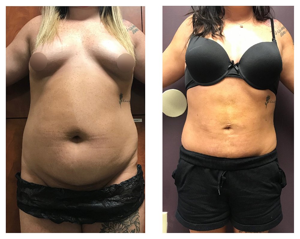 BodytiteLipo-SmartLipo-2M-after