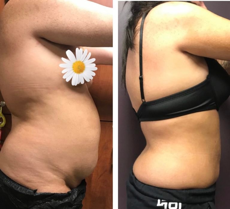 BodytiteLipo
