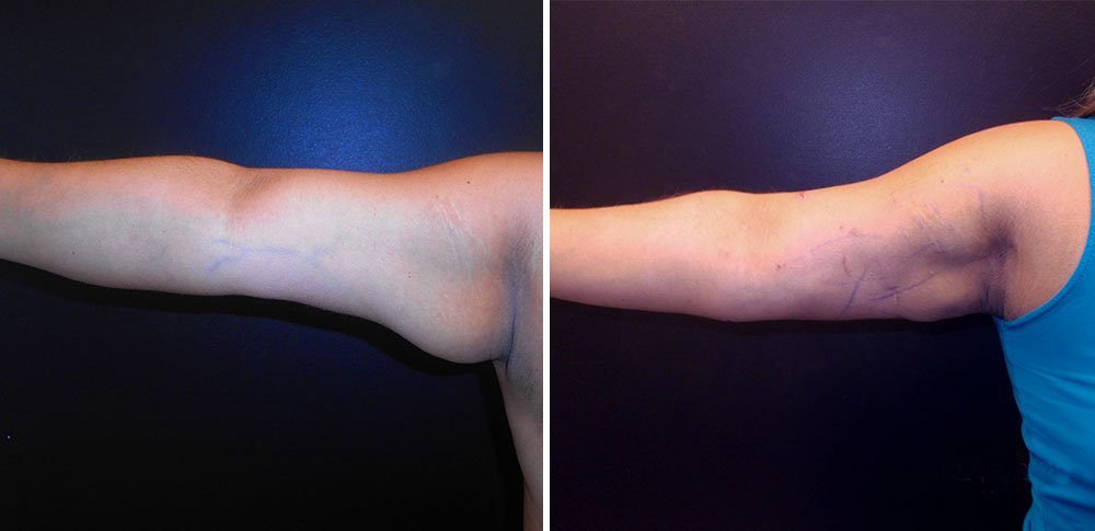 BodytiteLipo-arms-lipo