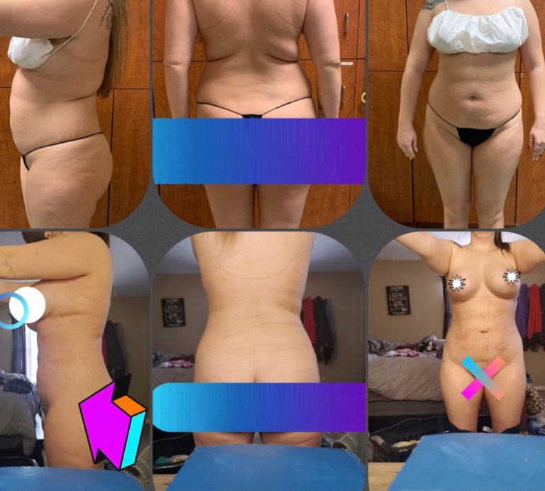 BodytiteLipo-lipo