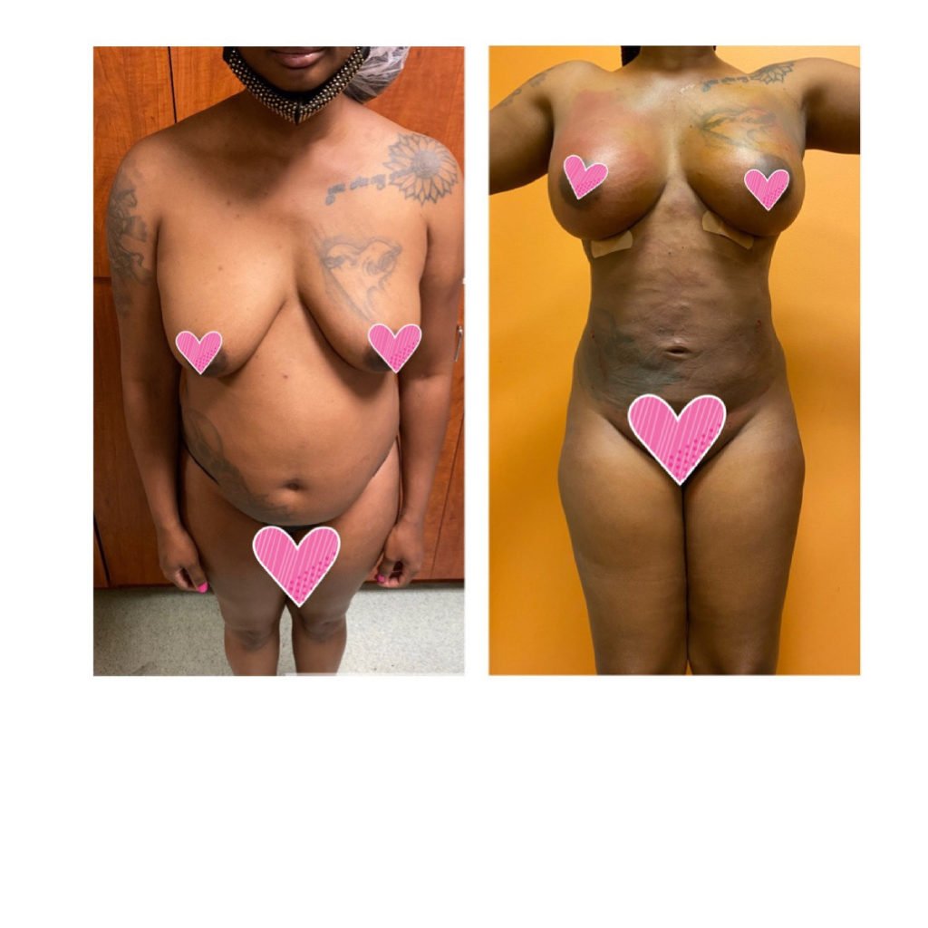 BodytiteLipo-lipo-360-and-fat-transfer1-day
