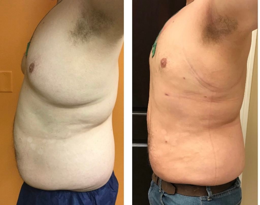 BodytiteLipo-lipo-7w