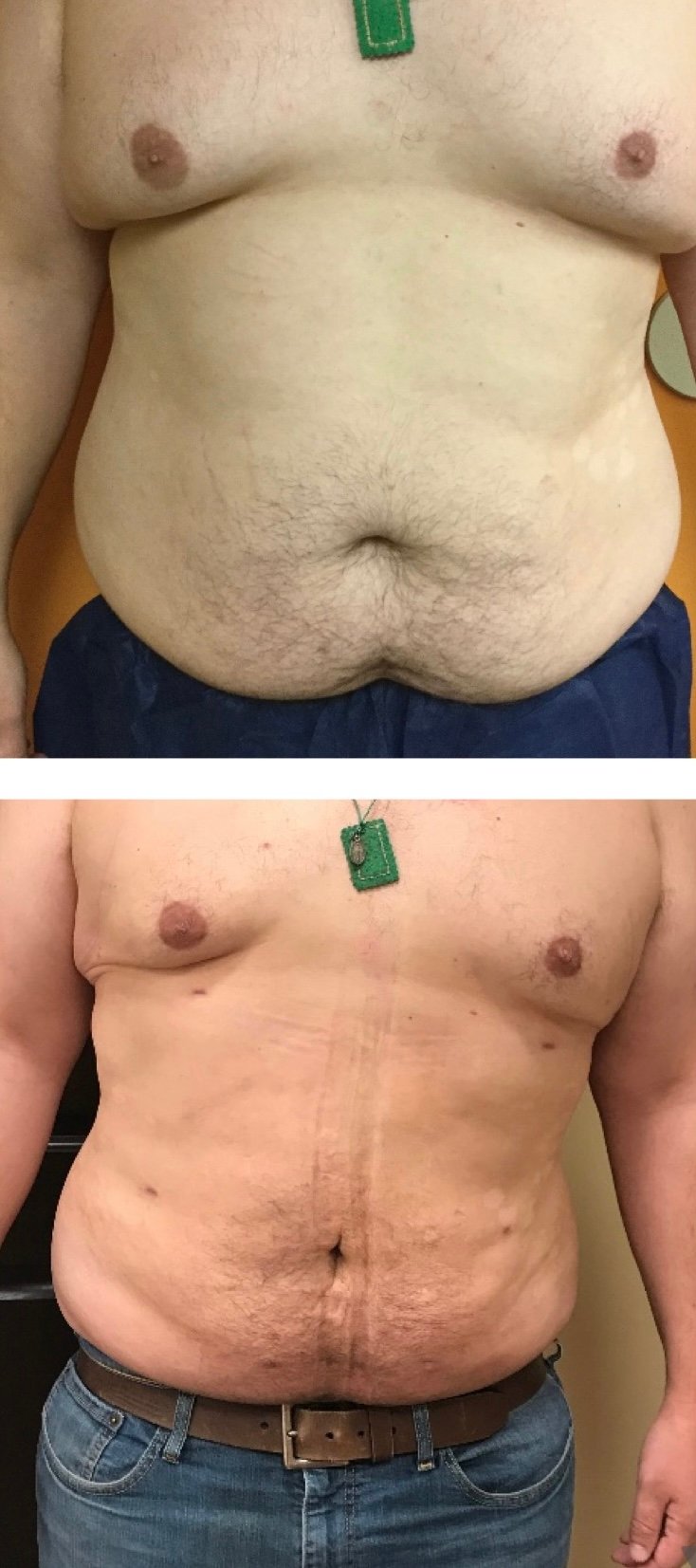 BodytiteLipo-lipo-after