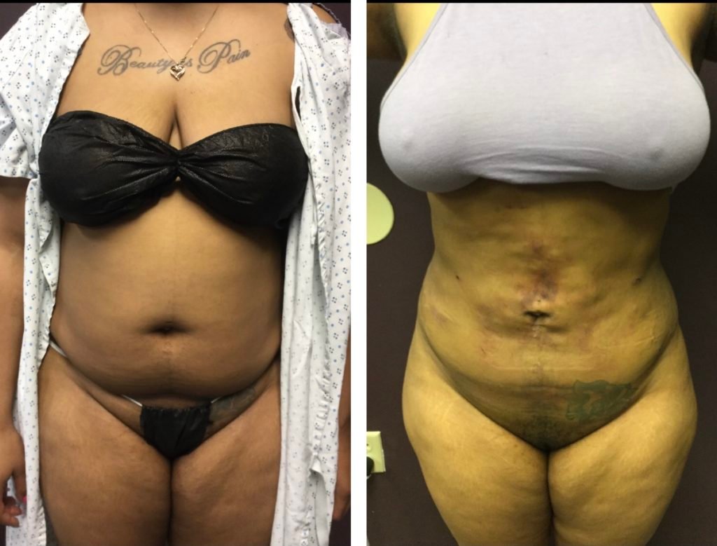 BodytiteLipo-lipo-and-body-tite-3-days-after