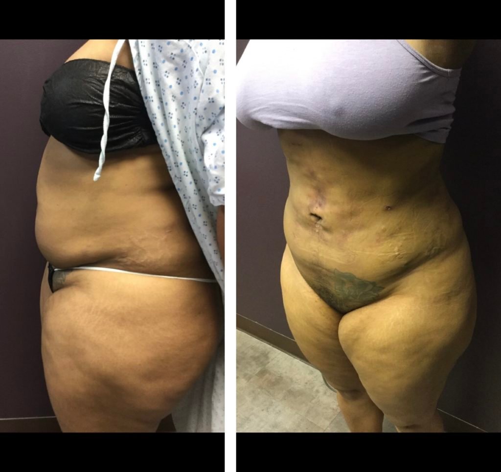 BodytiteLipo-lipo-and-body-tite-3-days-after-side