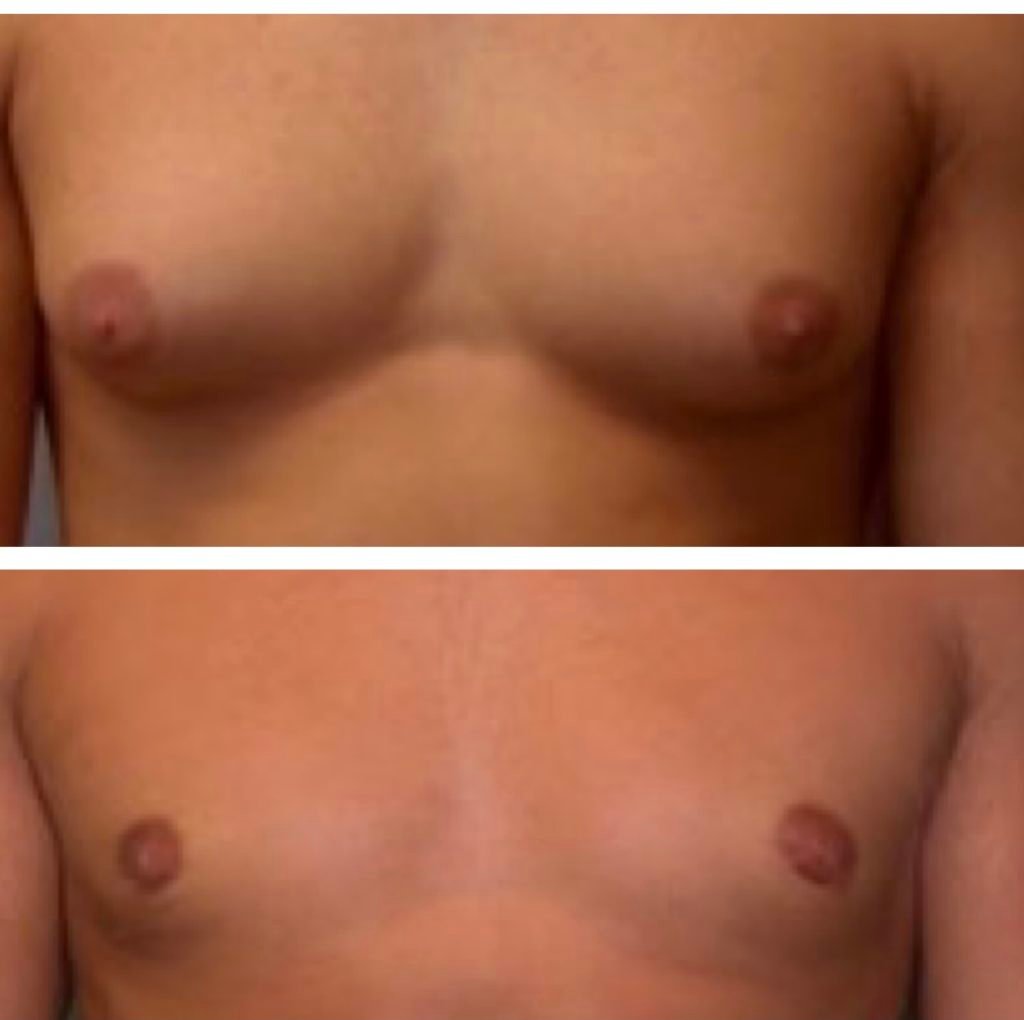 BodytiteLipo-lipo-gynemacostia-12weeks-after