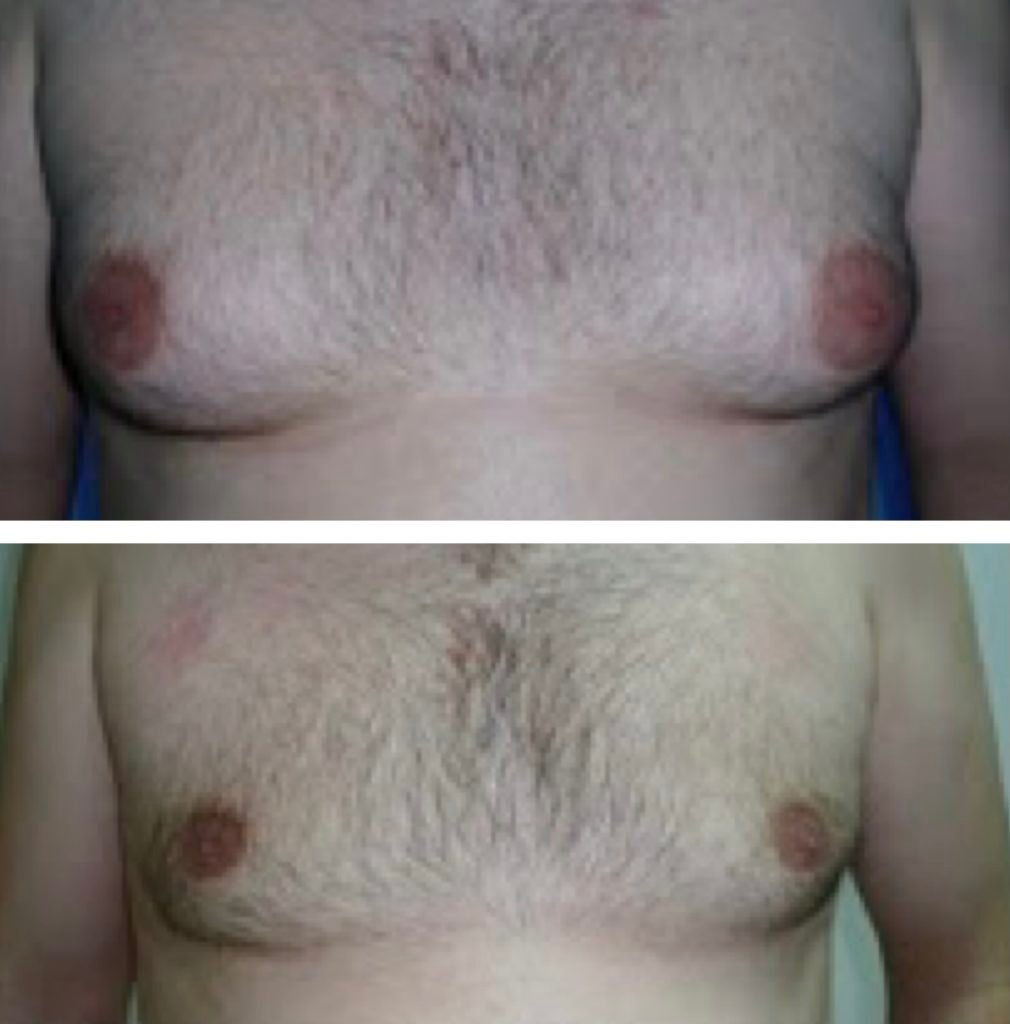 BodytiteLipo-lipo-gynemacostia-4M-after