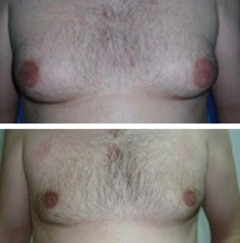 BodytiteLipo-lipo-gynemacostia