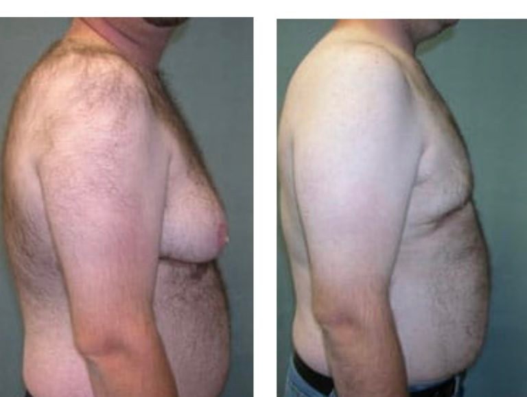 BodytiteLipo-lipo-gynemacostia