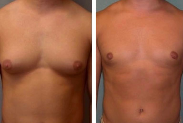 BodytiteLipo-lipo-gynemacostia