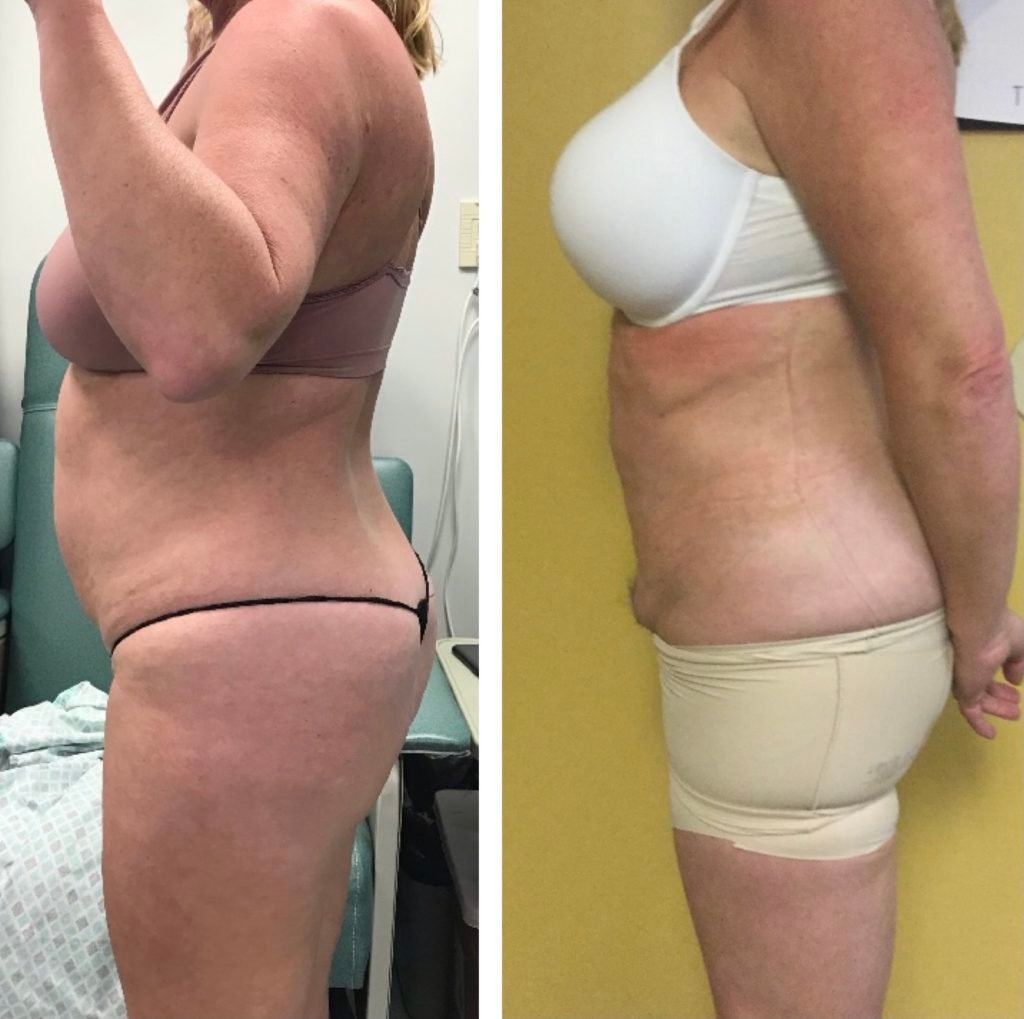 BodytiteLipo-lipo-pafter-3M