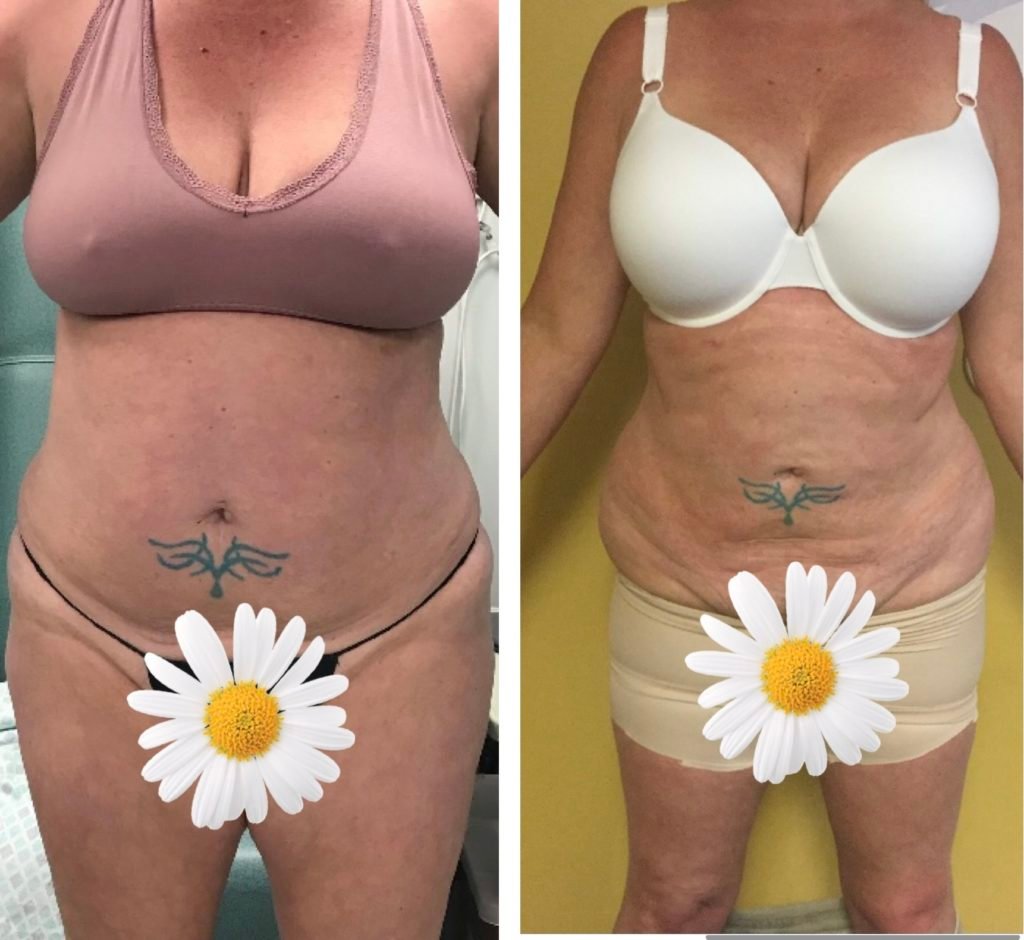 BodytiteLipo-lipo-pafter-3M