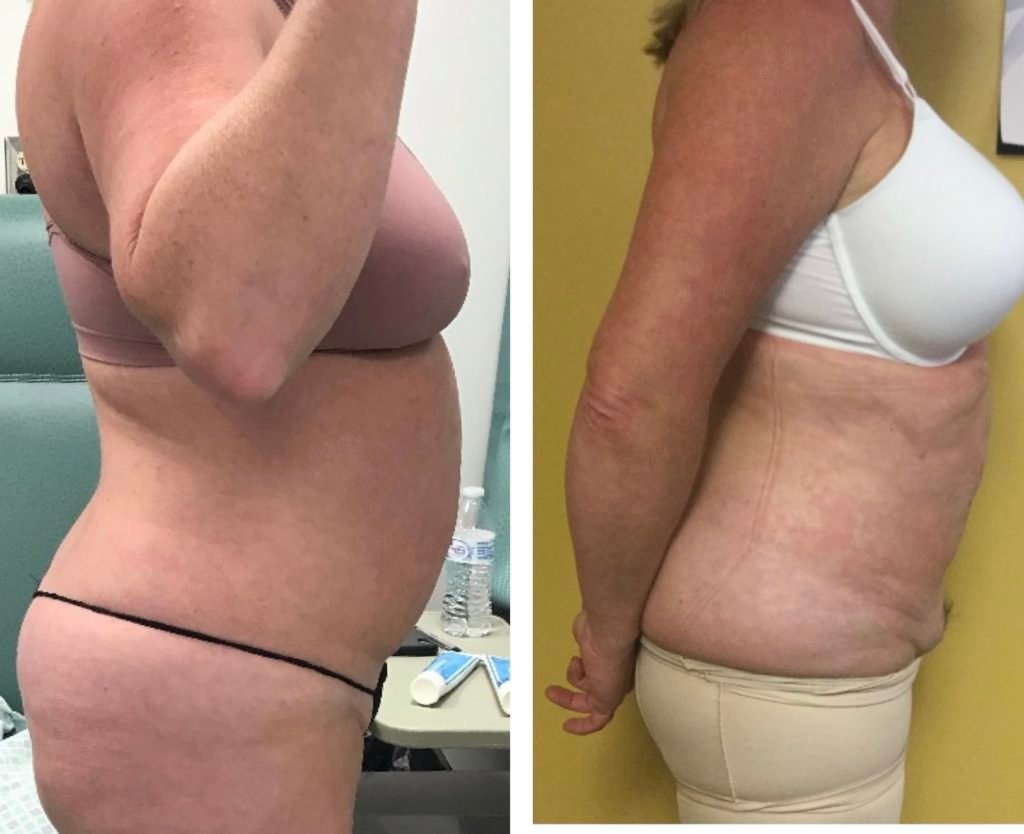 BodytiteLipo-lipo-pafter-3M