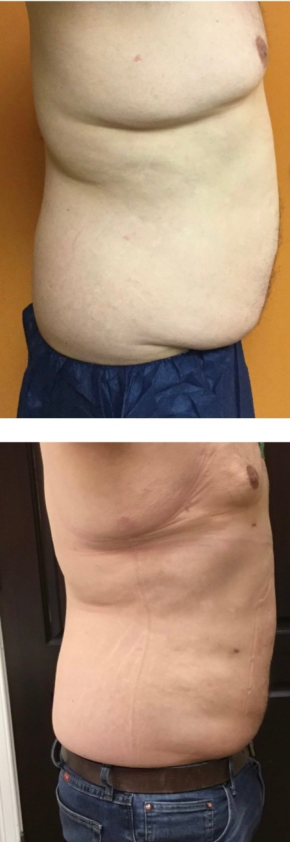 BodytiteLipo-lipo