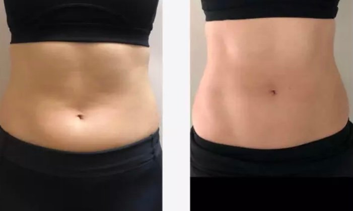 EMSculpt-NEO-emsculpt-neo-4tx