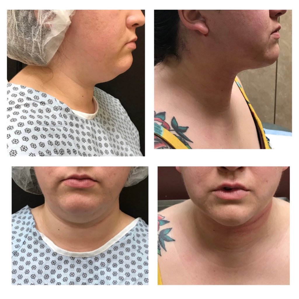 Facetitelipo-Facetite-SmartLipo-1-day-after