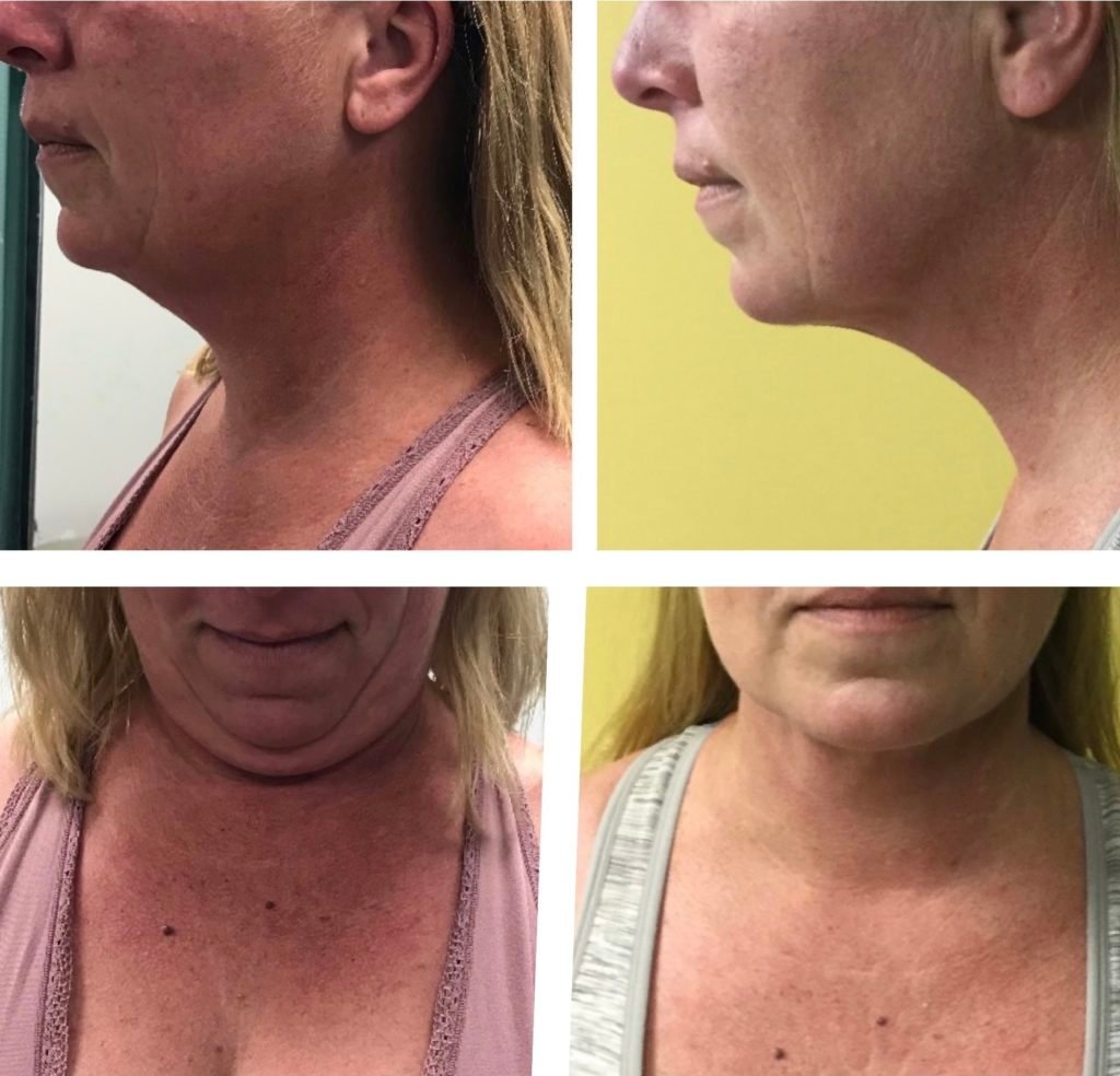 Facetitelipo-Facetite-SmartLipo