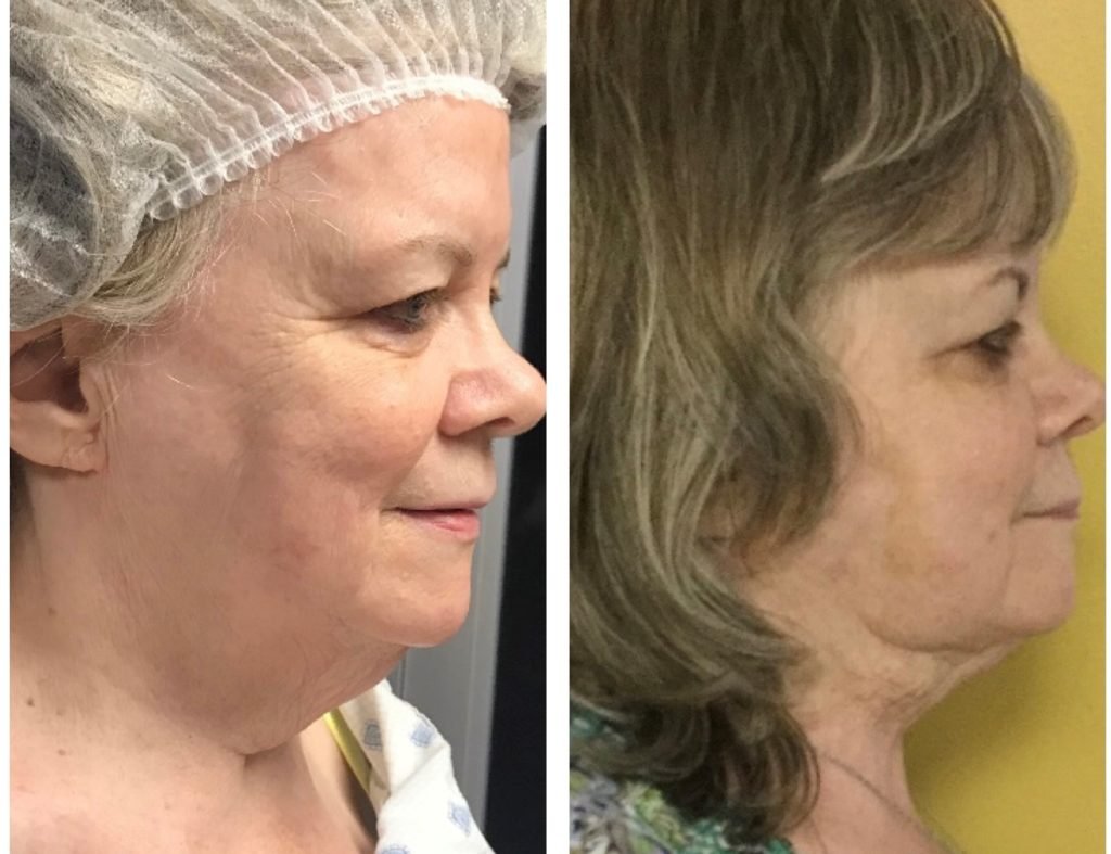 Facetitelipo-Facetite-SmartLipo-4-weeks-after