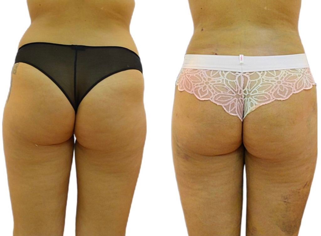 Fat-Transfer-1M-after