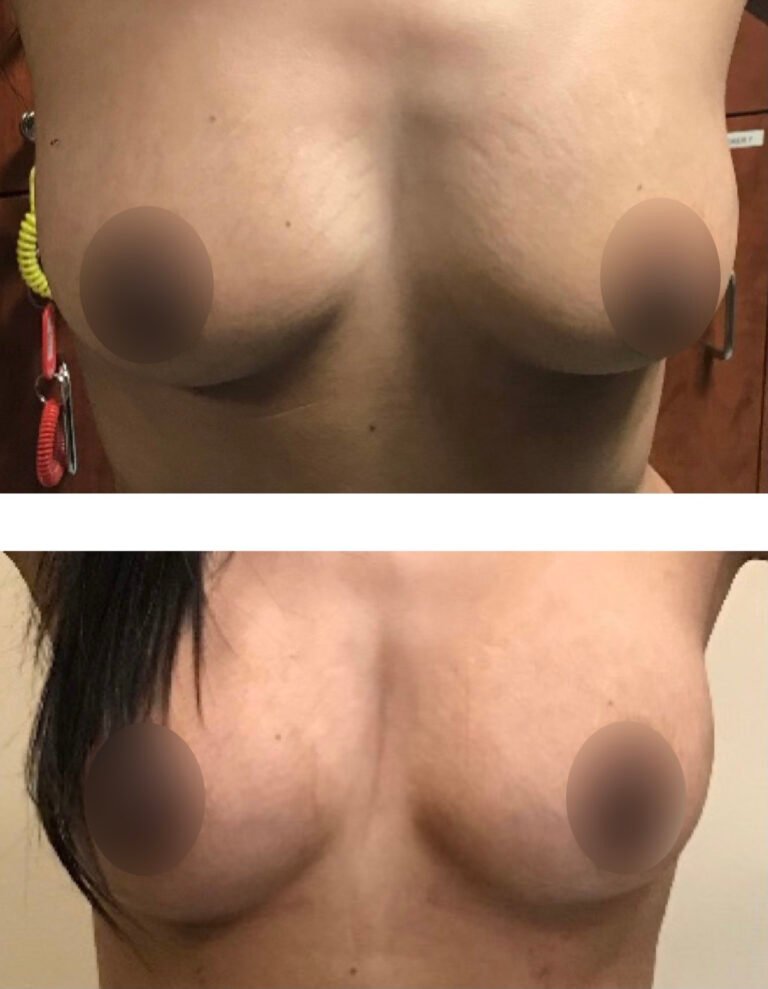 Fat-Transfer