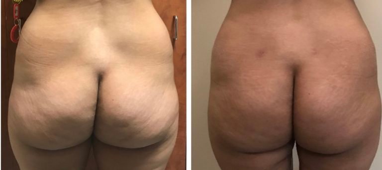 Fat-Transfer