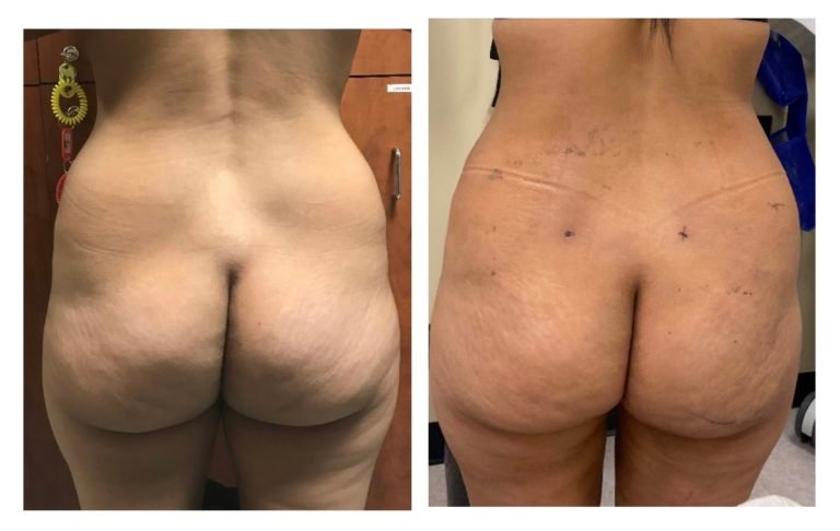 Fat-Transfer