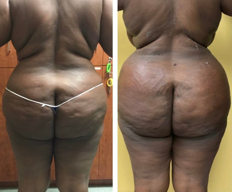 Fat-Transfer-fat-transfer