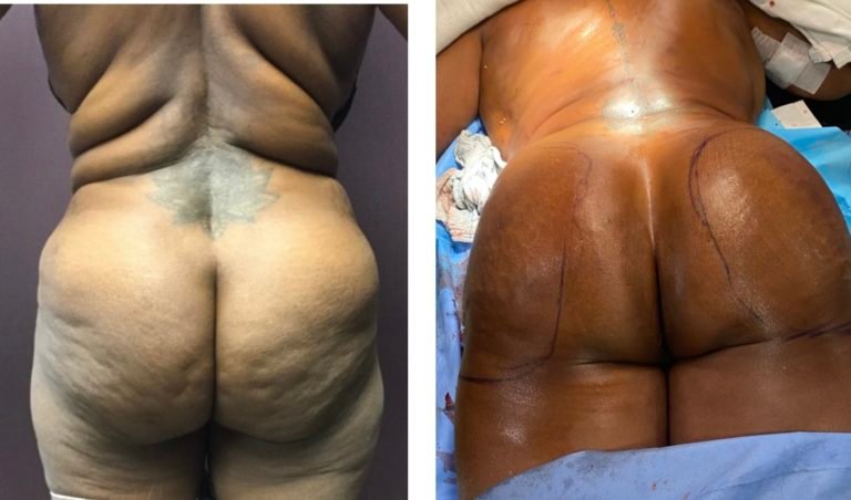 Fat-Transfer