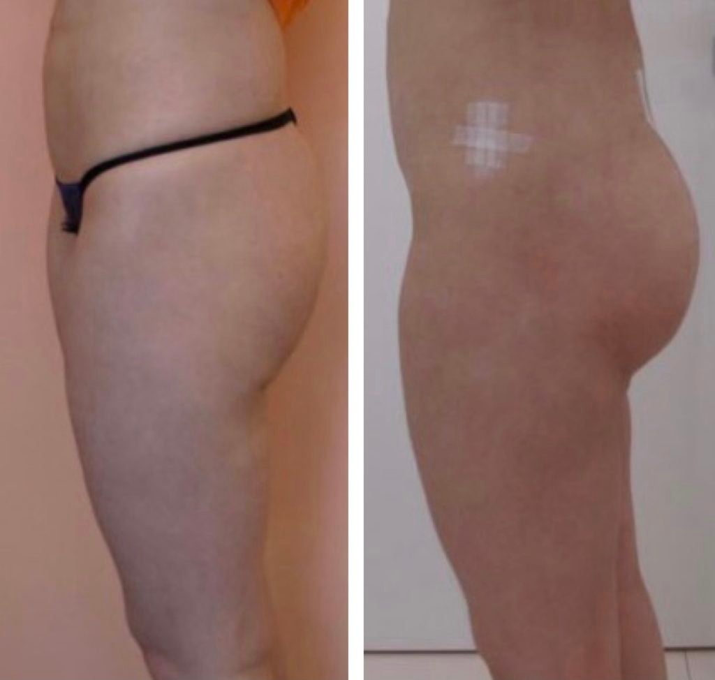 Fat-transfer-10-days-week-after