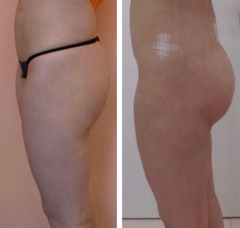 Fat-Transfer