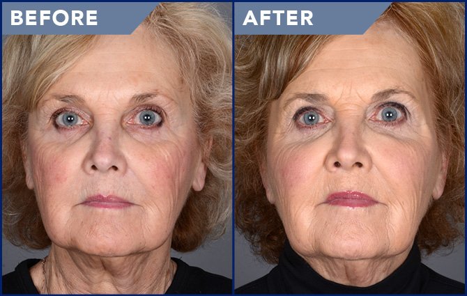 Filler-Voluma-Juvederm