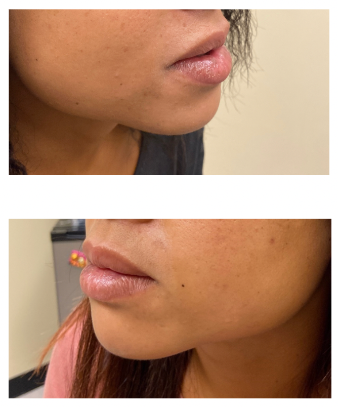 Filler-fillerbeforeafter