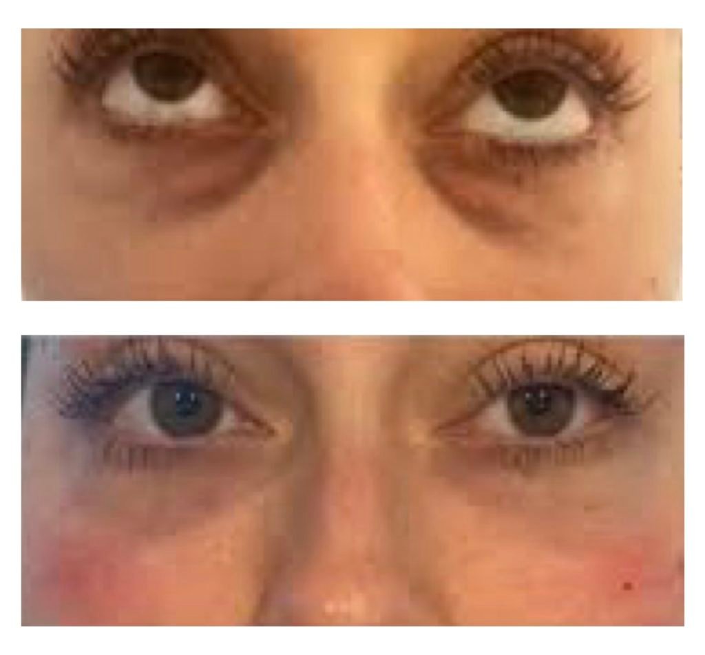 Dermal Fillers