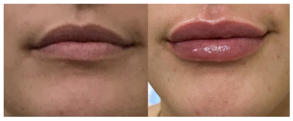 Filler-lipfiller