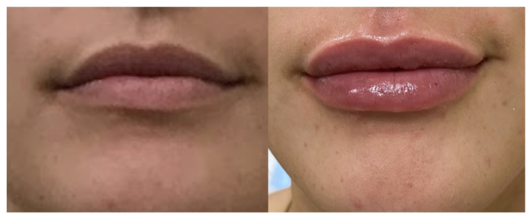 Filler-lipfiller