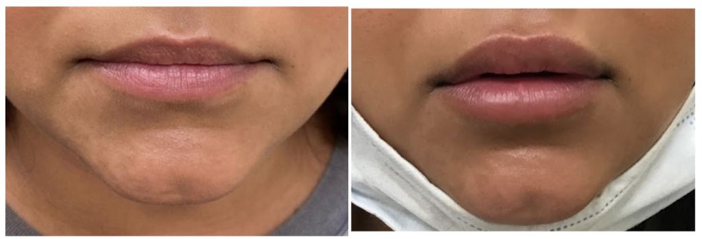 Filler-lipfiller